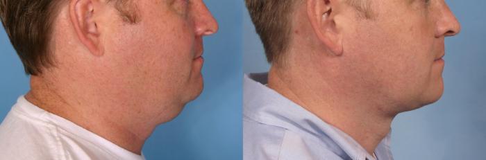 Before & After Male Face/Neck Lift Case 108 View #2 View in Naples and Ft. Myers, FL