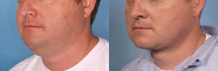 Before & After Male Face/Neck Lift Case 108 View #3 View in Naples and Ft. Myers, FL