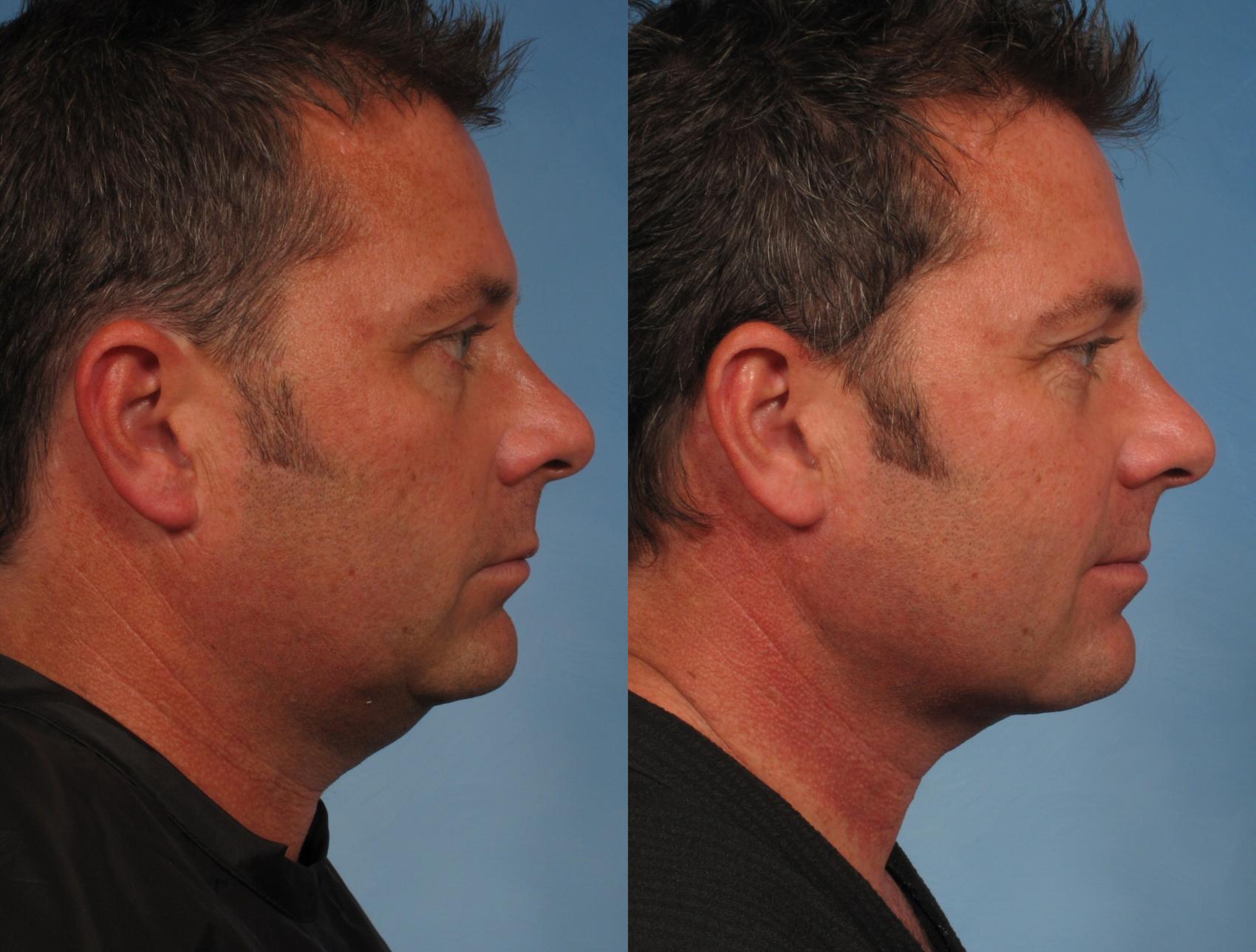 男性面部/颈部提拉手术前后情况163视图1在那不勒斯和佛罗里达州迈尔斯堡的视图