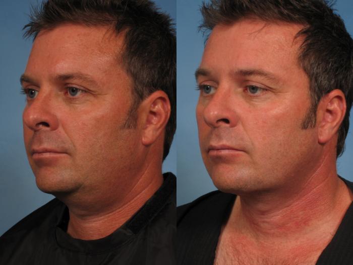 Before & After Male Face/Neck Lift Case 163 View #2 View in Naples and Ft. Myers, FL