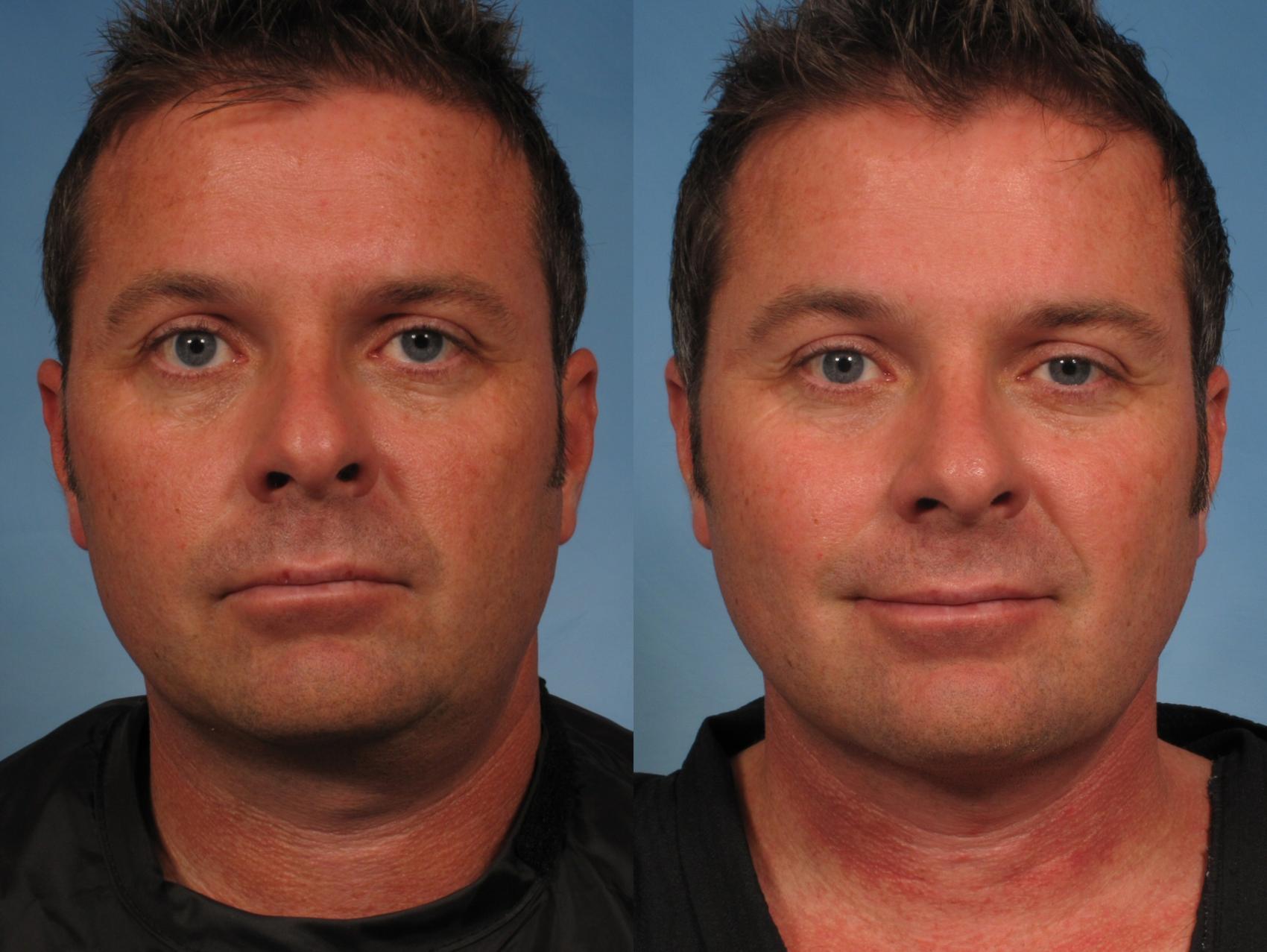 Male Faceneck Lift Before And After Pictures Case 163 Naples And Ft