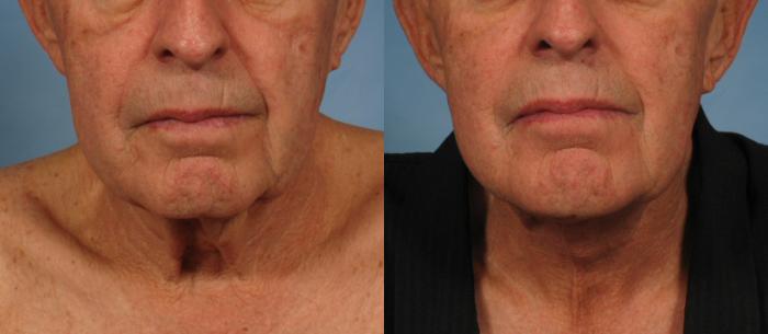 Before & After Male Face/Neck Lift Case 186 View #1 View in Naples and Ft. Myers, FL