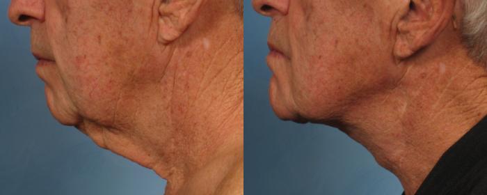 Before & After Male Face/Neck Lift Case 186 View #3 View in Naples and Ft. Myers, FL