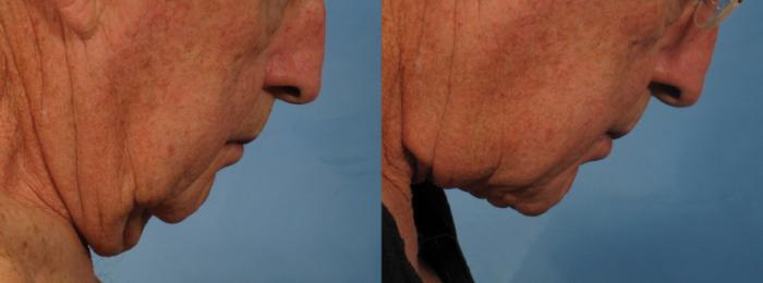 Before & After Male Face/Neck Lift Case 186 View #4 View in Naples and Ft. Myers, FL