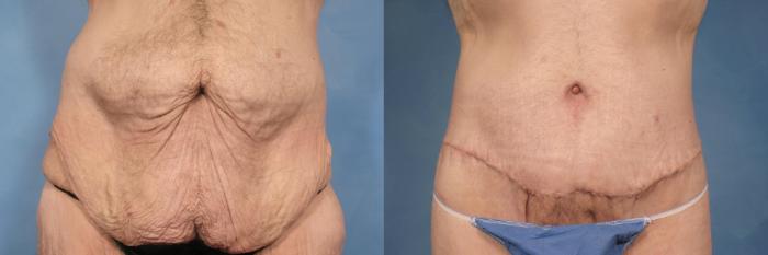 Before & After Massive Weight Loss Case 104 View #2 View in Naples and Ft. Myers, FL