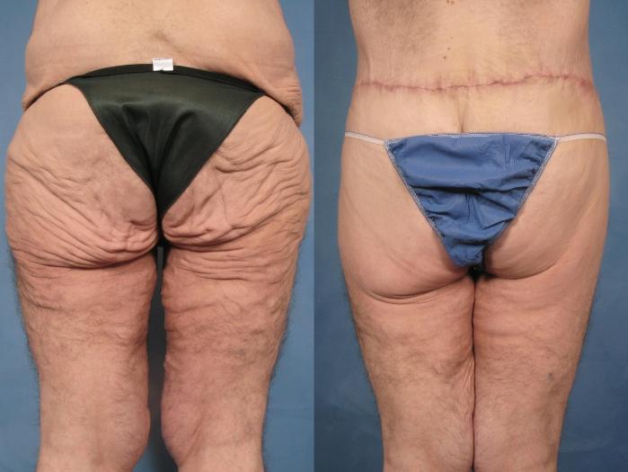 Before & After Massive Weight Loss Case 104 View #4 View in Naples and Ft. Myers, FL