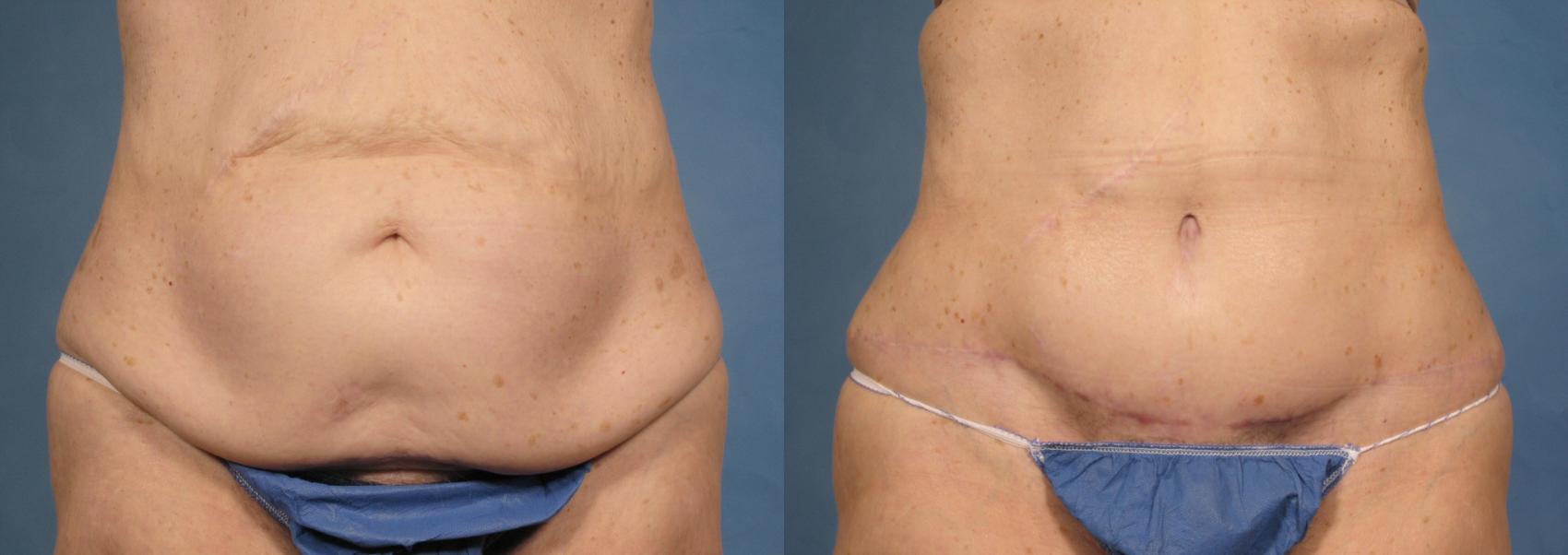 Before & After Massive Weight Loss Case 173 View #1 View in Naples and Ft. Myers, FL