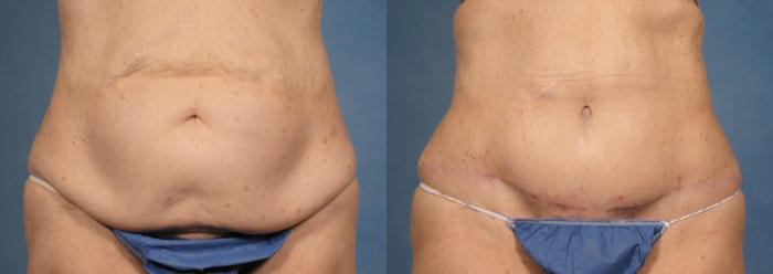 Before & After Massive Weight Loss Case 173 View #1 View in Naples and Ft. Myers, FL
