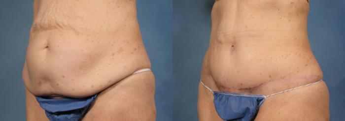 Before & After Massive Weight Loss Case 173 View #2 View in Naples and Ft. Myers, FL