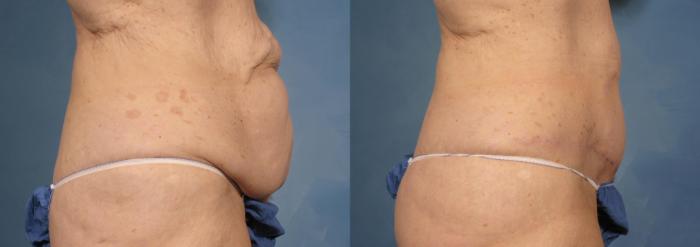 Before & After Massive Weight Loss Case 173 View #3 View in Naples and Ft. Myers, FL