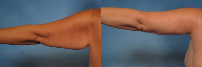 Before & After Massive Weight Loss Case 194 View #2 View in Naples and Ft. Myers, FL