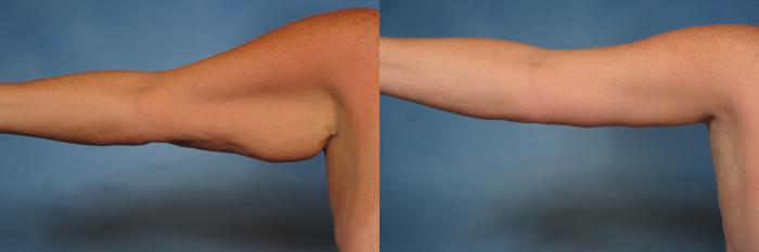 Before & After Massive Weight Loss Case 194 View #3 View in Naples and Ft. Myers, FL