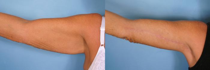 Before & After Massive Weight Loss Case 22 View #1 View in Naples and Ft. Myers, FL
