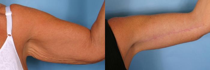 Before & After Massive Weight Loss Case 22 View #4 View in Naples and Ft. Myers, FL