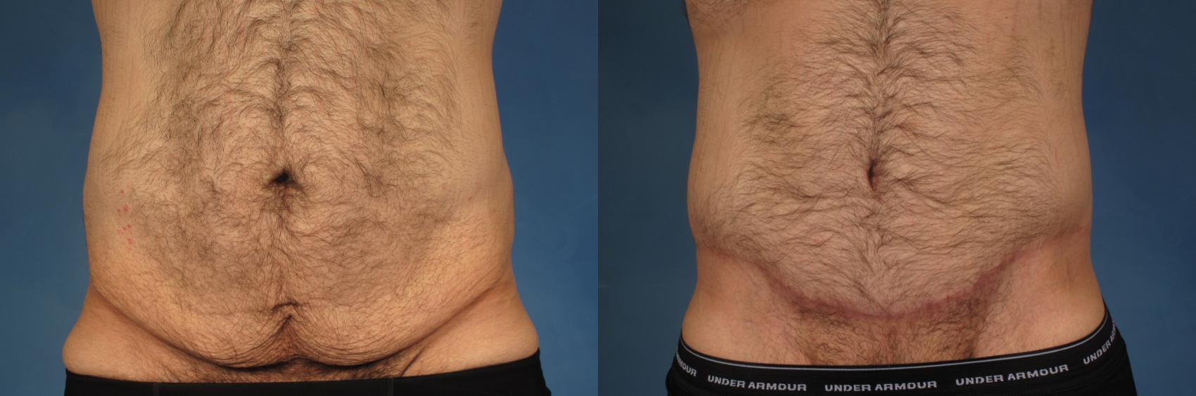 Transformative Body Contouring Post-Weight Loss - Cosmedical