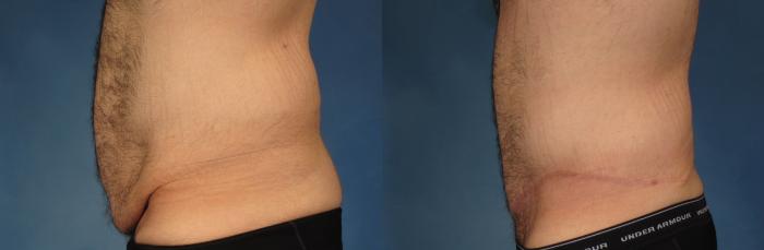 Before & After Massive Weight Loss Case 244 View #2 View in Naples and Ft. Myers, FL