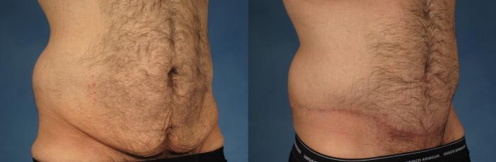 Before & After Massive Weight Loss Case 244 View #3 View in Naples and Ft. Myers, FL
