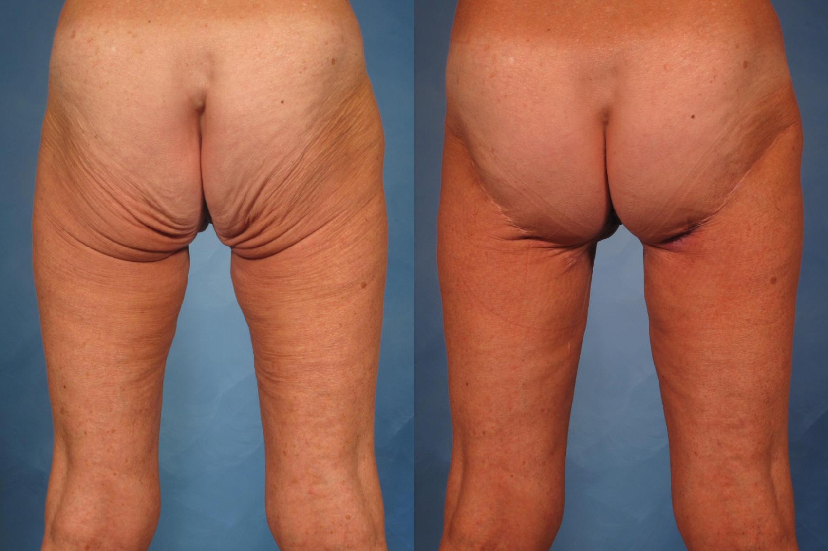 Before & After Massive Weight Loss Case 247 View #1 View in Naples and Ft. Myers, FL