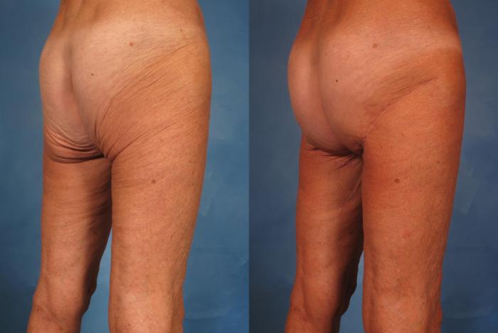 Before & After Massive Weight Loss Case 247 View #3 View in Naples and Ft. Myers, FL