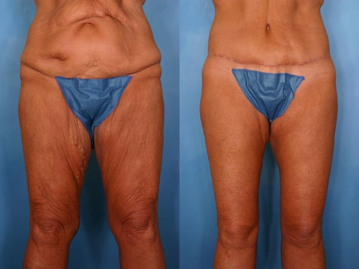 Before & After Massive Weight Loss Case 89 View #1 View in Naples and Ft. Myers, FL