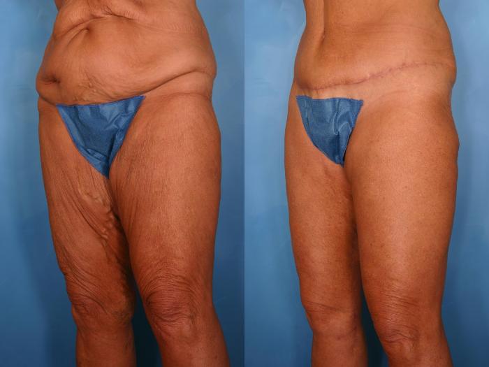 Before & After Massive Weight Loss Case 89 View #2 View in Naples and Ft. Myers, FL