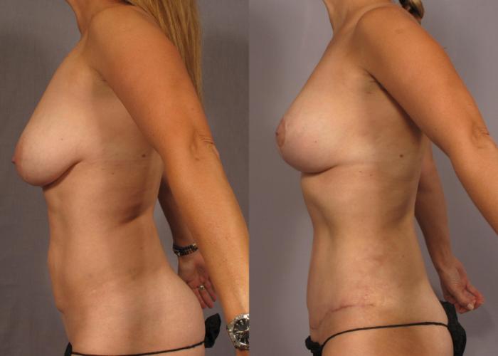 Before & After Mommy Makeover Case 314 View #3 View in Naples and Ft. Myers, FL