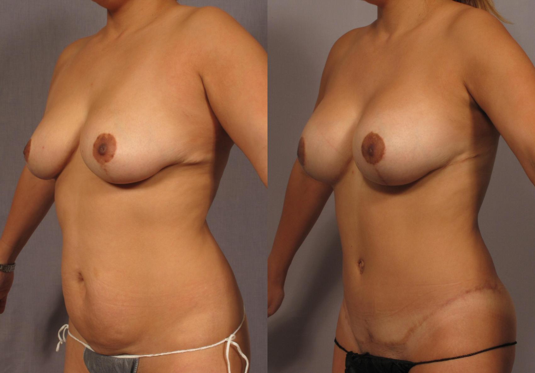 Before & After Mommy Makeover Case 315 View #2 View in Naples and Ft. Myers, FL