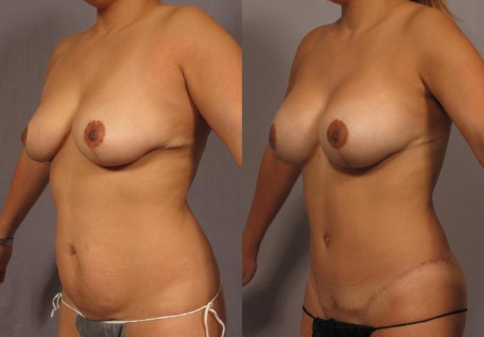 Before & After Mommy Makeover Case 315 View #2 View in Naples and Ft. Myers, FL