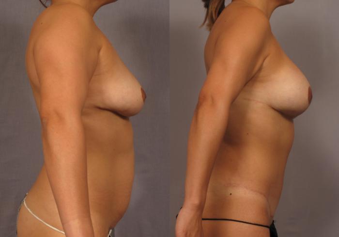 Before & After Mommy Makeover Case 315 View #3 View in Naples and Ft. Myers, FL