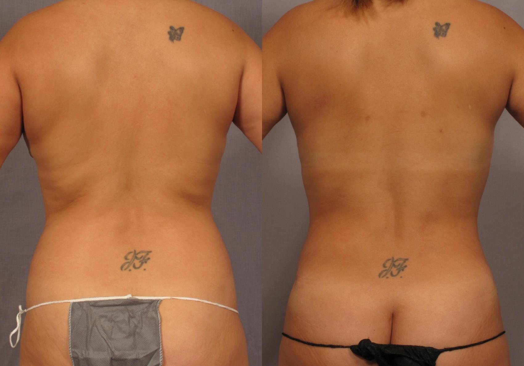 Before & After Mommy Makeover Case 315 View #4 View in Naples and Ft. Myers, FL