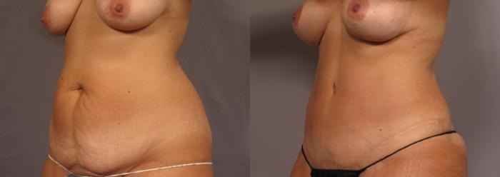 Before & After Mommy Makeover Case 334 View #2 View in Naples and Ft. Myers, FL