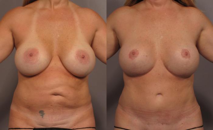 Before & After Mommy Makeover Case 336 View #1 View in Naples and Ft. Myers, FL
