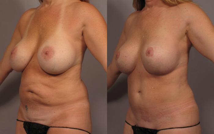 Before & After Mommy Makeover Case 336 View #2 View in Naples and Ft. Myers, FL