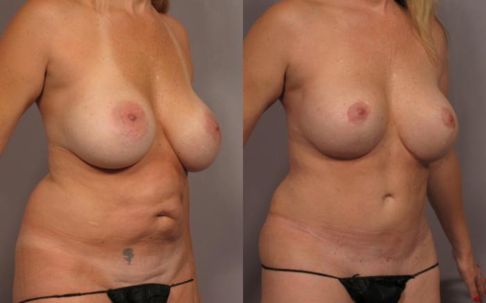Before & After Mommy Makeover Case 336 View #3 View in Naples and Ft. Myers, FL