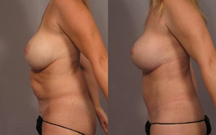 Before & After Mommy Makeover Case 336 View #4 View in Naples and Ft. Myers, FL