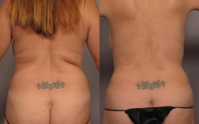 Before & After Mommy Makeover Case 336 View #5 View in Naples and Ft. Myers, FL