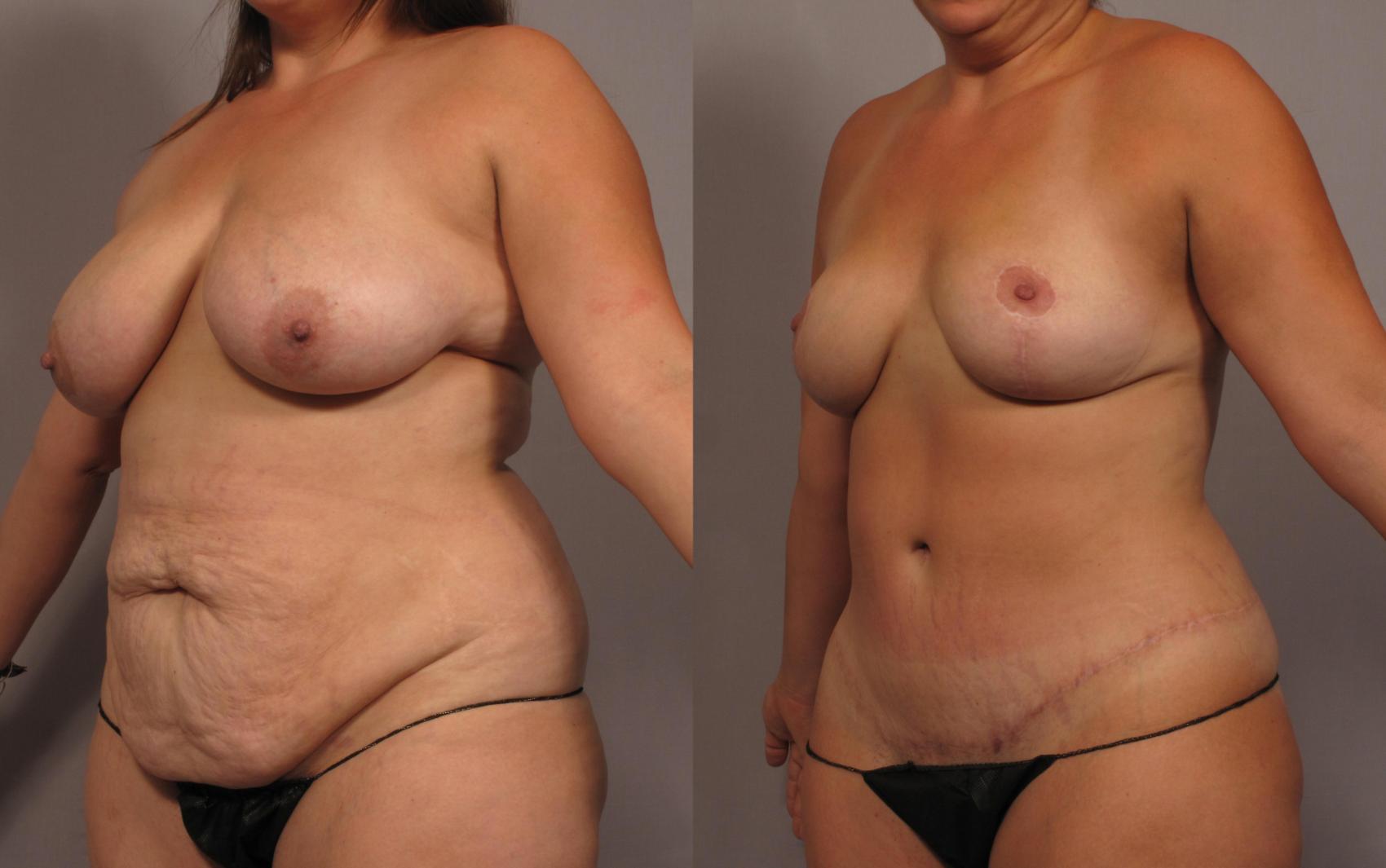 Mommy Makeover Before and 1 Year After, Left Oblique