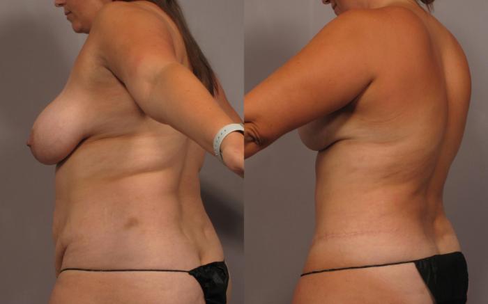 Mommy Makeover Before and 1 Year After, Left Posterior Oblique
