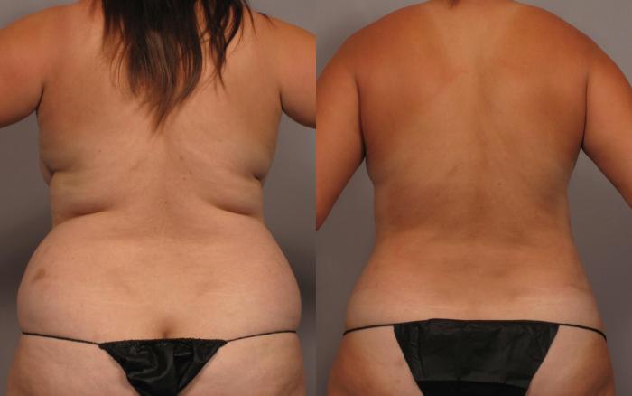 Mommy Makeover Before and 1 Year After, Posterior