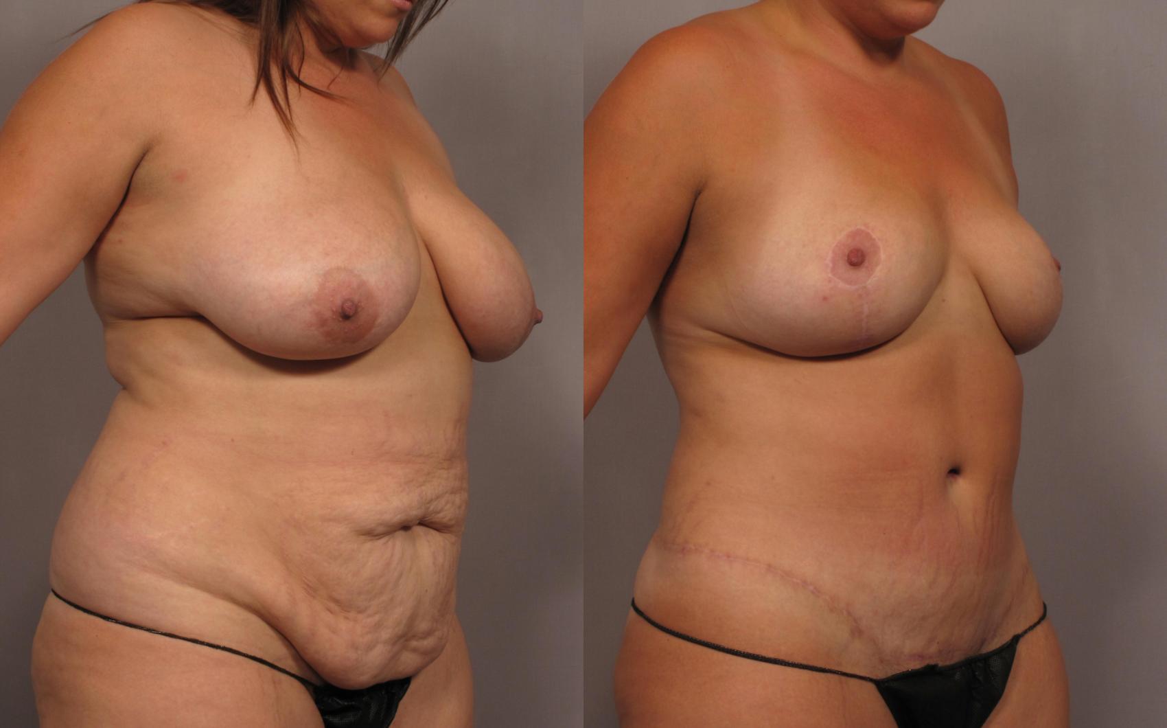 Mommy Makeover Before and 1 Year After, Left Oblique