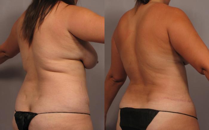 Mommy Makeover Before and 1 Year After, Right Posterior Oblique
