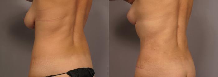 Posterior Oblique view preop of Mommy Makeover Patient