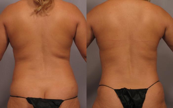 Back View of Dr. Hasen's patient who had Mommy Makeover, Before