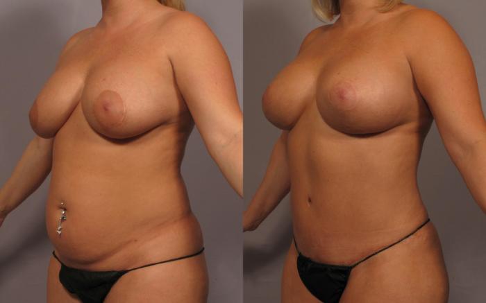 Left Oblique View of Dr. Hasen's patient who had Mommy Makeover, Before