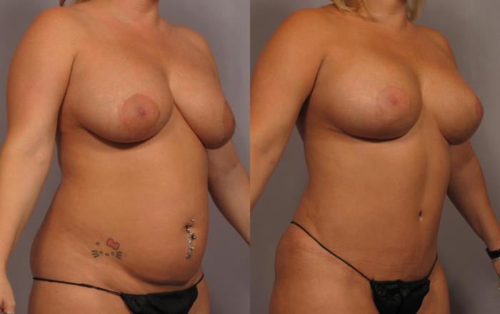 Right Oblique View of Dr. Hasen's patient who had Mommy Makeover, Before