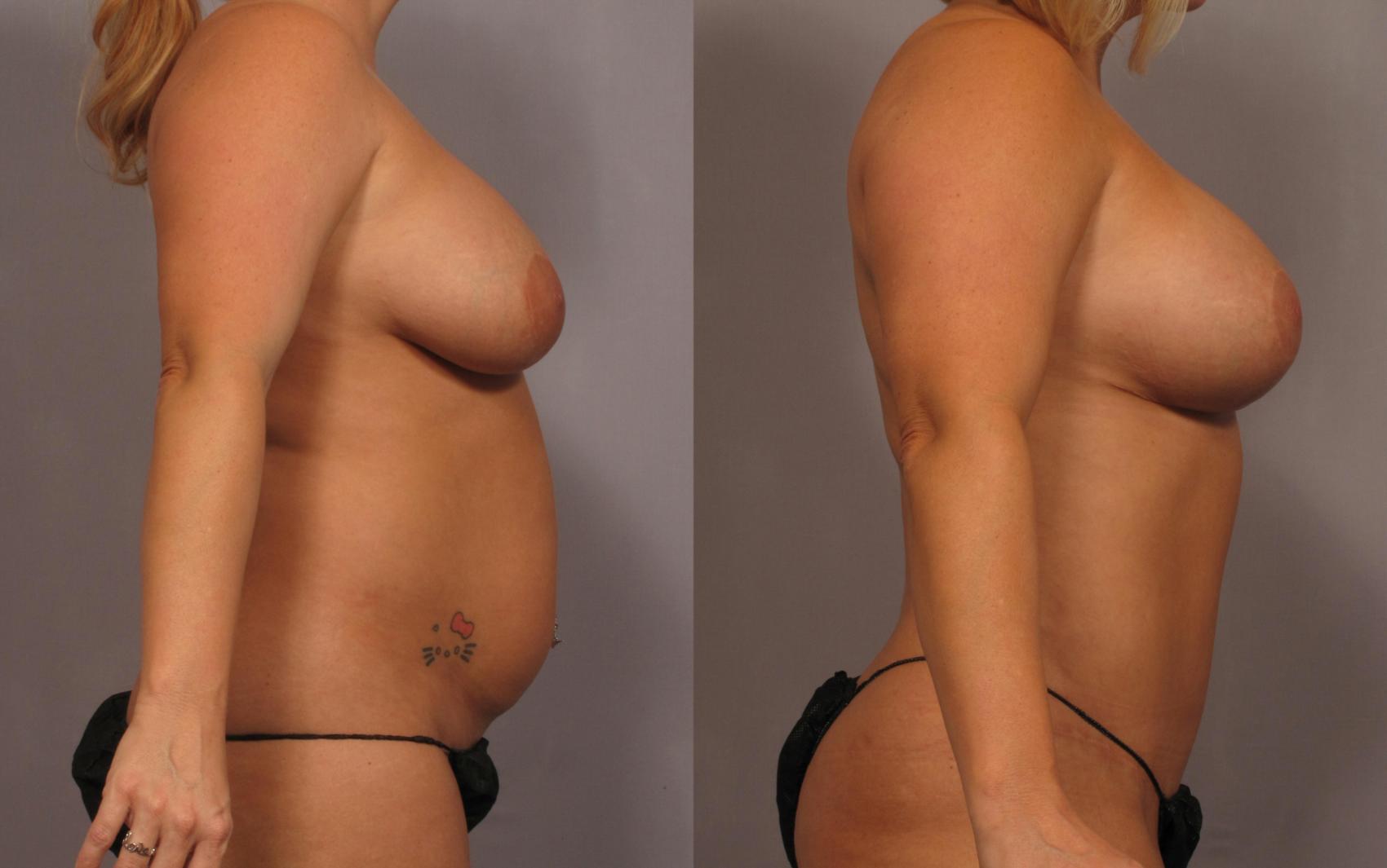 Right Side View of Dr. Hasen's patient who had Mommy Makeover, Before