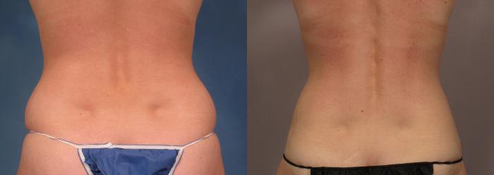 Mommy Makeover, Posterior View, Before and 7 Years After Photos by Dr. Kent V. Hasen