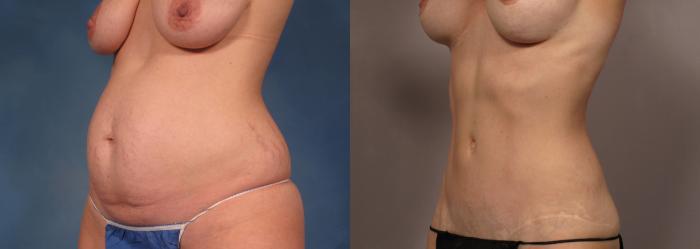 Mommy Makeover, Left Oblique, Before and 7 years After Photos by Dr. Kent V. Hasen