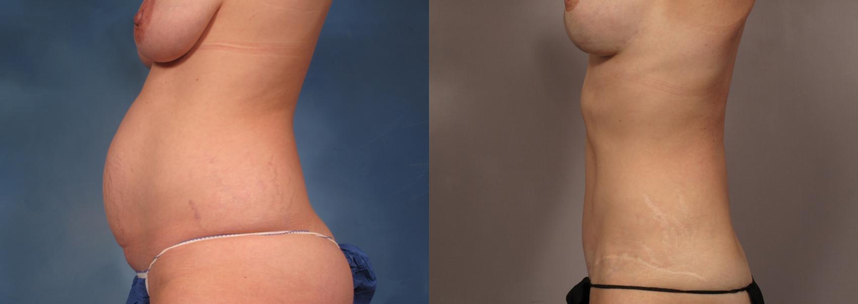 Mommy Makeover, Left Side View, Before and 7 years After Photos by Dr. Kent V. Hasen