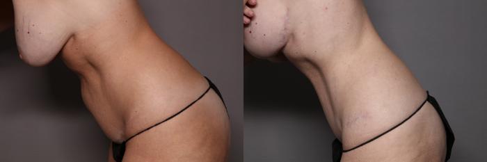 Tummy Tuck, Left Side Lean Down Pre Op